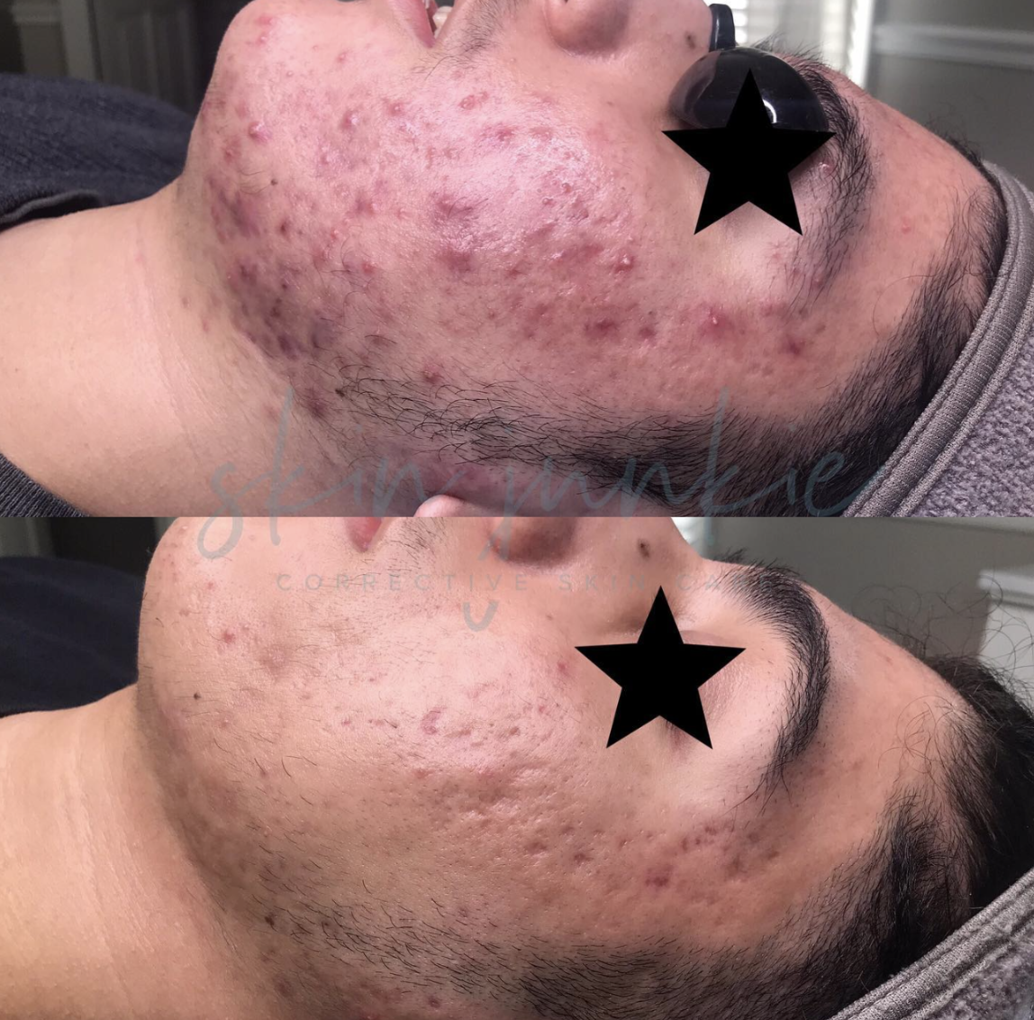 acne-solutions-program.png
