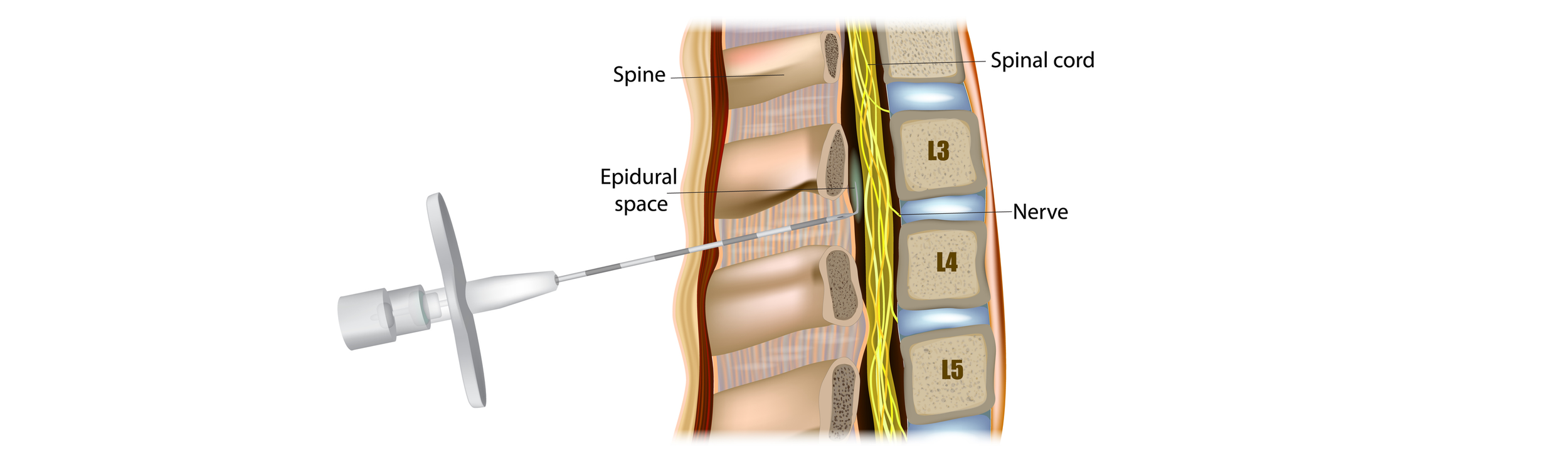 Epidural Steroid Injections A Guide to Spinal Pain Relief — Doug