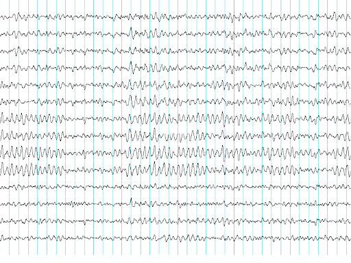 What Does a QEEG Brain Map Show?              Written by Colleen Longua BA, BCN-T, QEEG-T, ISF