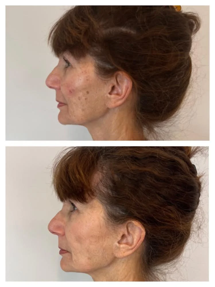 before and after bbl and moxi 1217