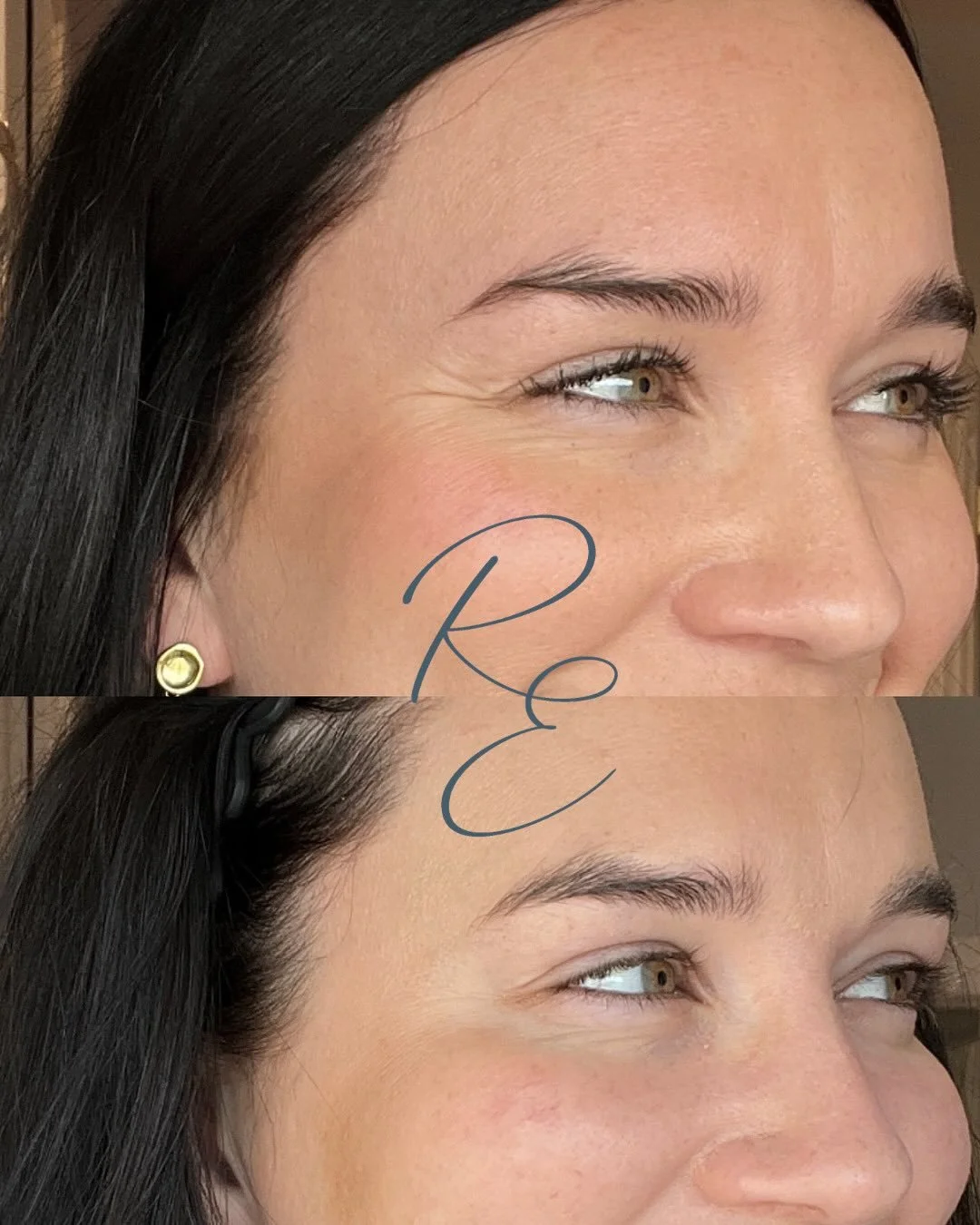 Natural looking results with Dysport, never too much but just enough ✨

Treated by @glowbyjuliahoran 

#radiantesthetics #Dysport #medicalspa #newportri