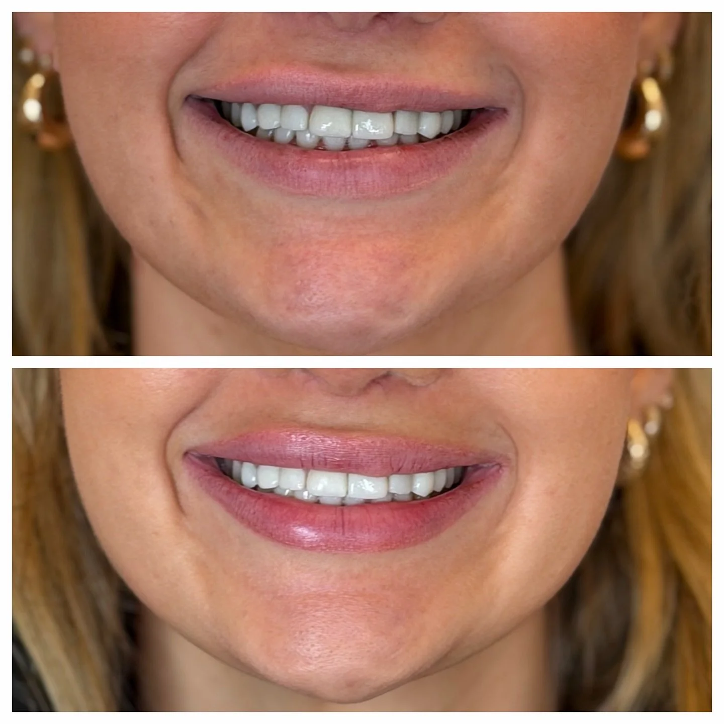 Subtle refresh before &amp; after✨

A little Botox + filler can go a long way! Carefully placed Botox relaxes targeted muscles to soften dominant depressor or &ldquo;pull down&rdquo; muscles, while strategic filler restores subtle volume and support.