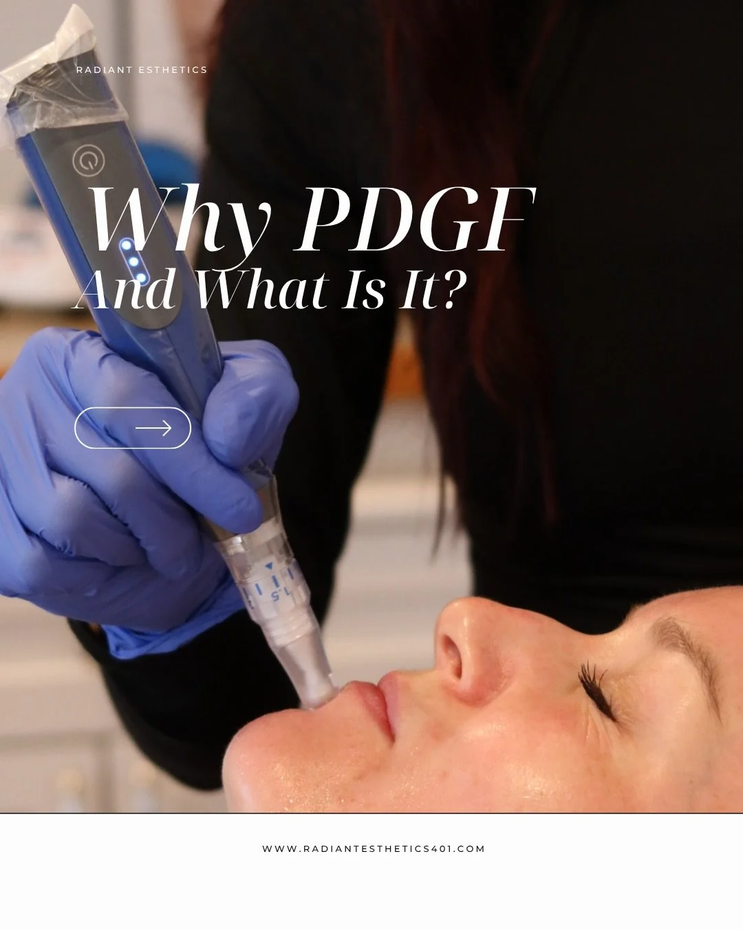 Learn more about why we love PDGF so much 🤍

PDGF, or platelet derived growth factor, can be tailored to a specific treatment for better healing and better results. The process is quick and easy and amazing for healthier, smoother looking skin.✨