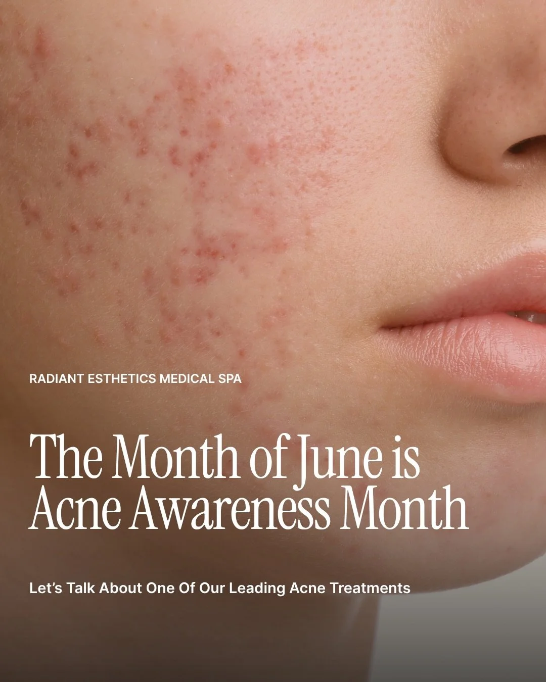 Treatment Spotlight: Broad Band Light for Acne ✨

BroadBand Light (BBL) therapy targets acne-causing bacteria deep within the skin while also helping to reduce inflammation and redness associated with active breakouts. Over time, BBL can improve over