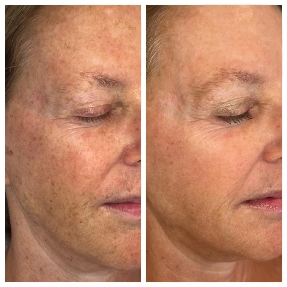 before and after bbl and moxi