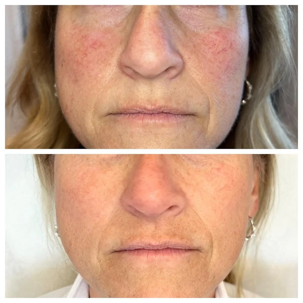 Before and after bbl and moxi 1218