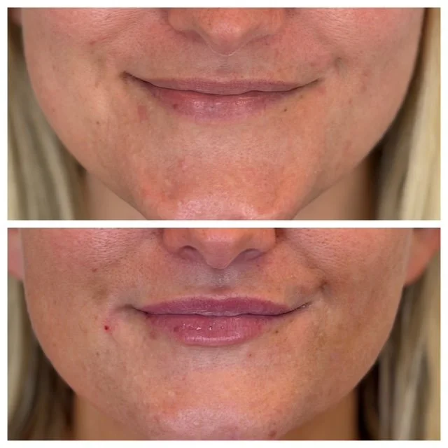 Lip Filler Results Natural