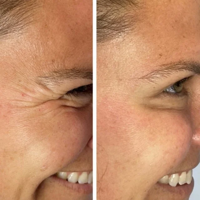 before and after crows feet neurotoxin