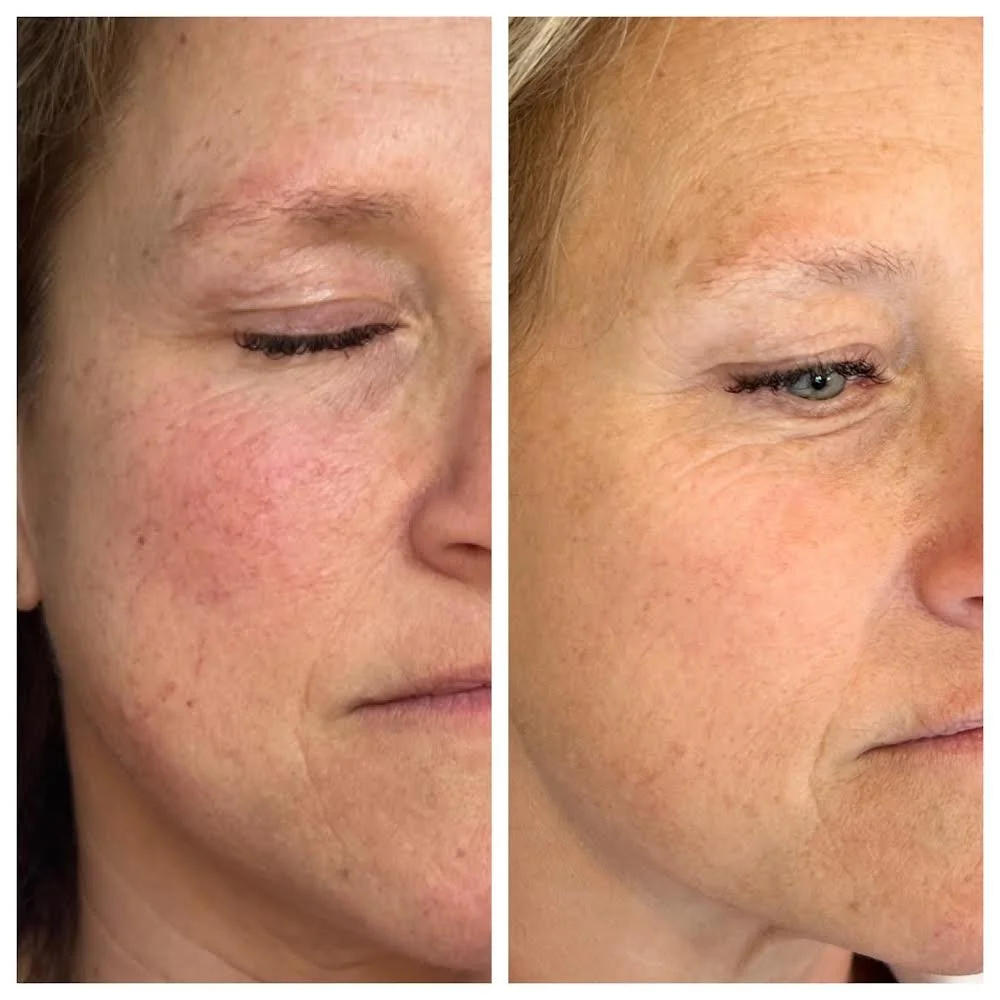 before and after bbl and moxi 1216