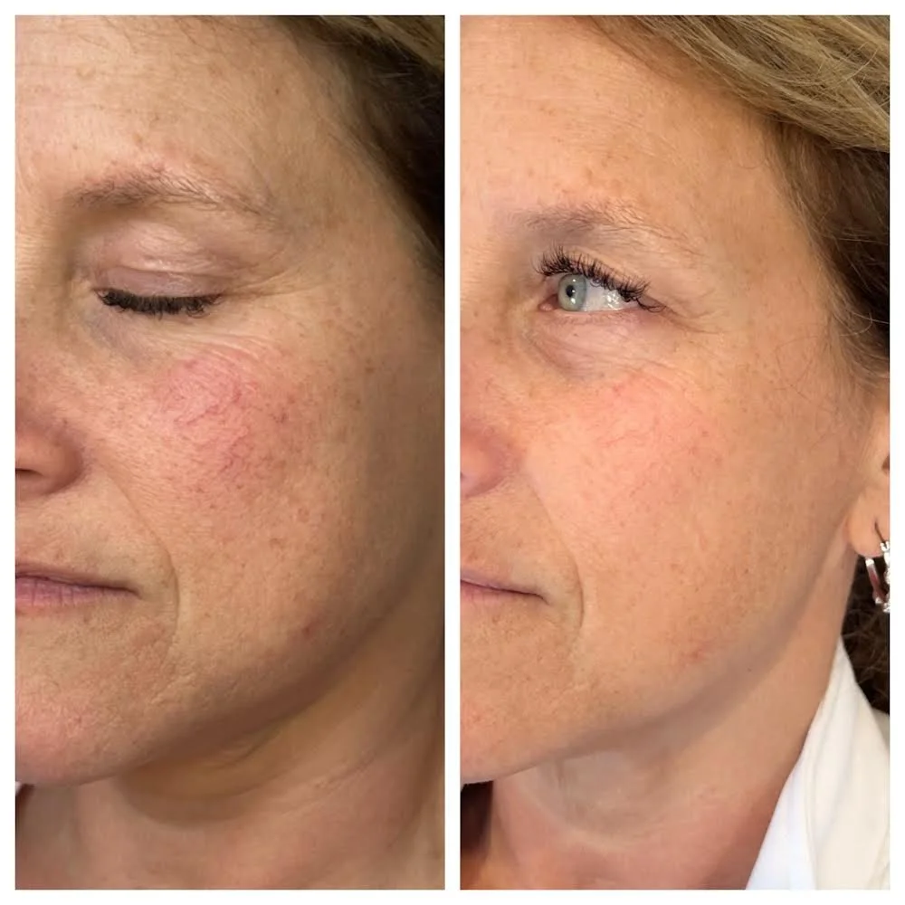 Before and after bbl and moxi 1219