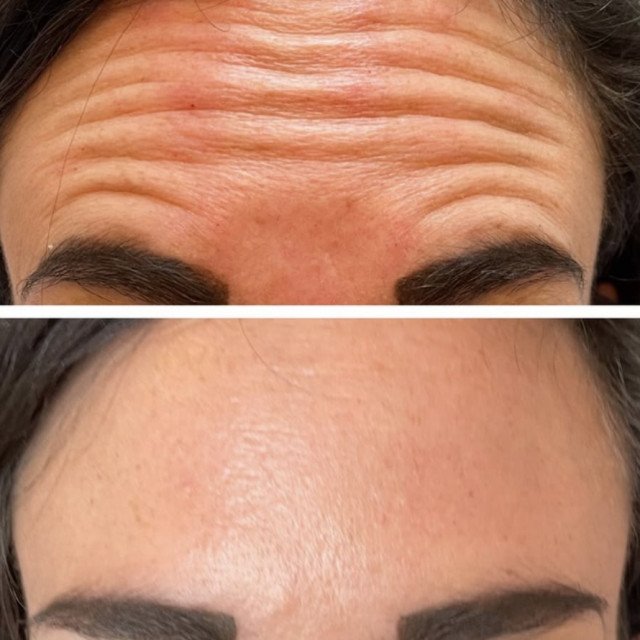 before and after frontalis neurotoxin