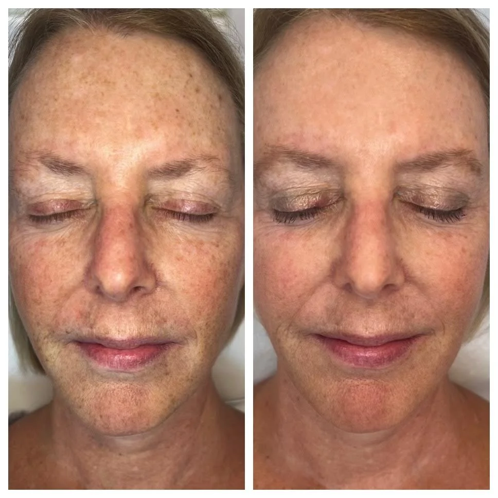 before and after bbl and moxi 1215