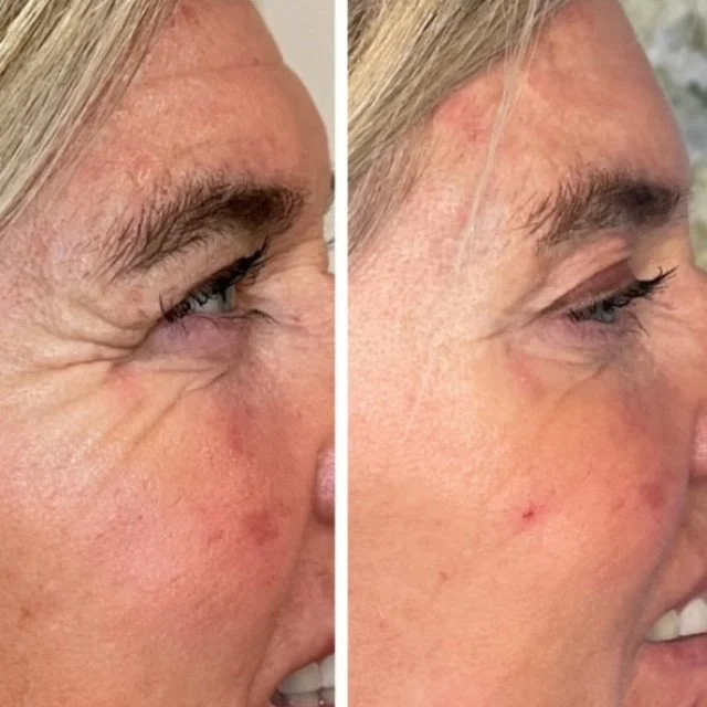 before and after crows feet neurotoxin