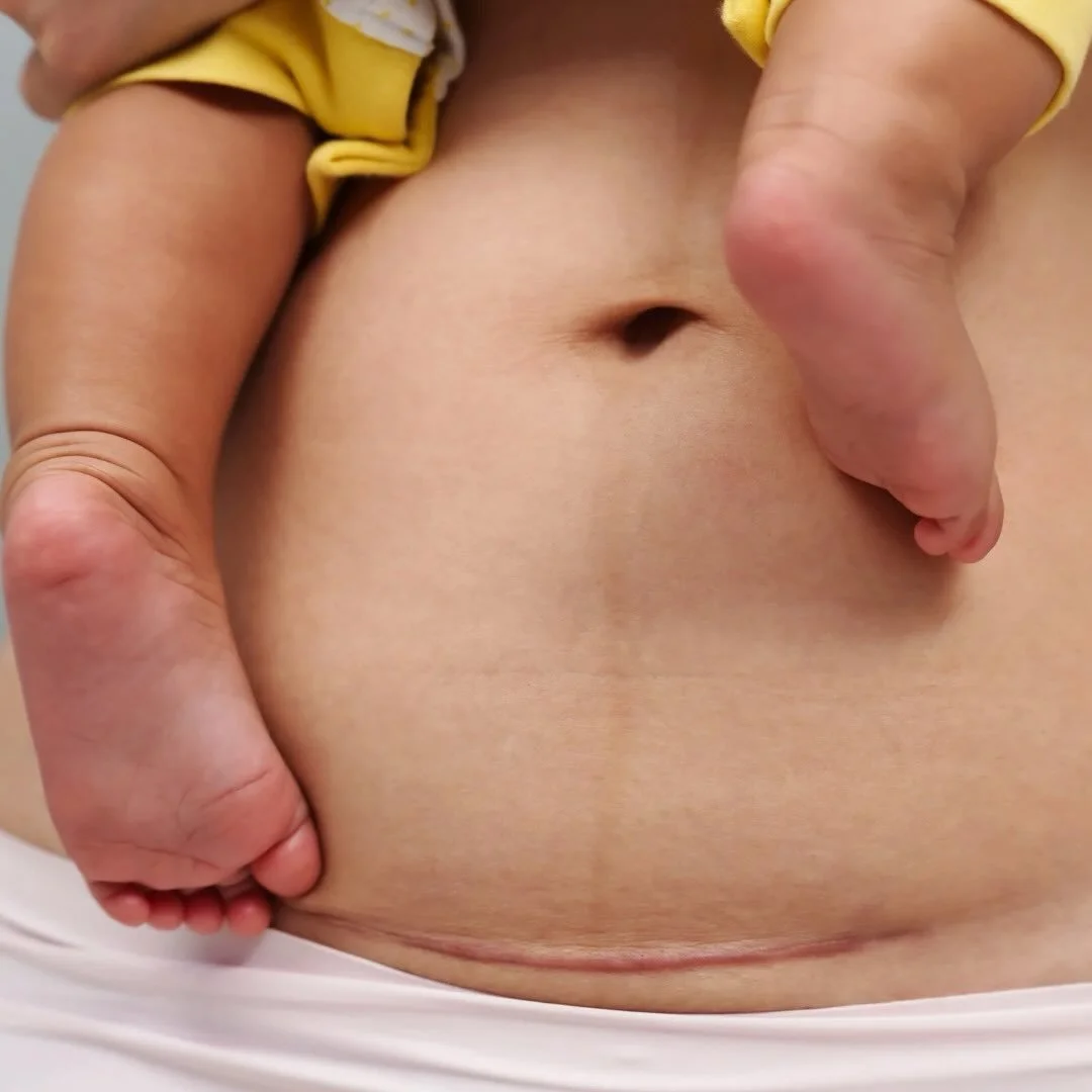 No one prepares you for how long C-section recovery can take.

Support is not a luxury; it is all part of healing.

#csectionawareness #motherhood #motherhoodtruths #postpartum