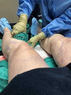 Medical professional in blue protective gear and gloves preparing a patient's legs for a procedure, with markings visible on the skin.