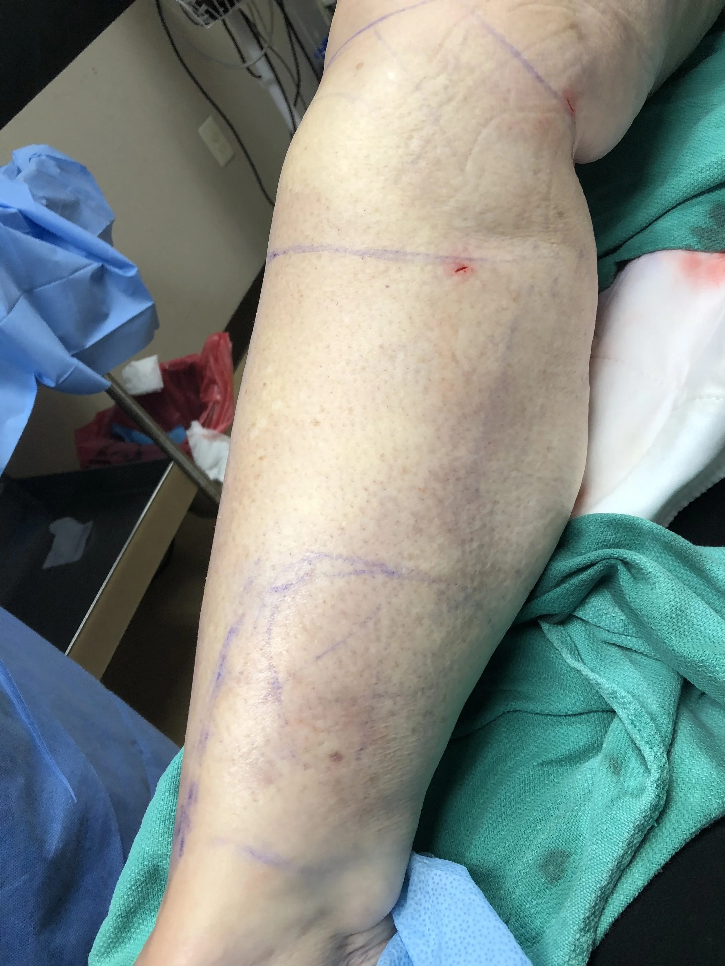 Close-up of a human leg with marked lines and small puncture wounds placed on an examination table covered with a green cloth. Blue medical drapes and supplies are in the background.