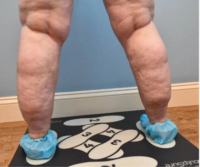Back view of a person's legs with cellulite, standing on a numbered foot positioning mat, wearing blue shoe covers.