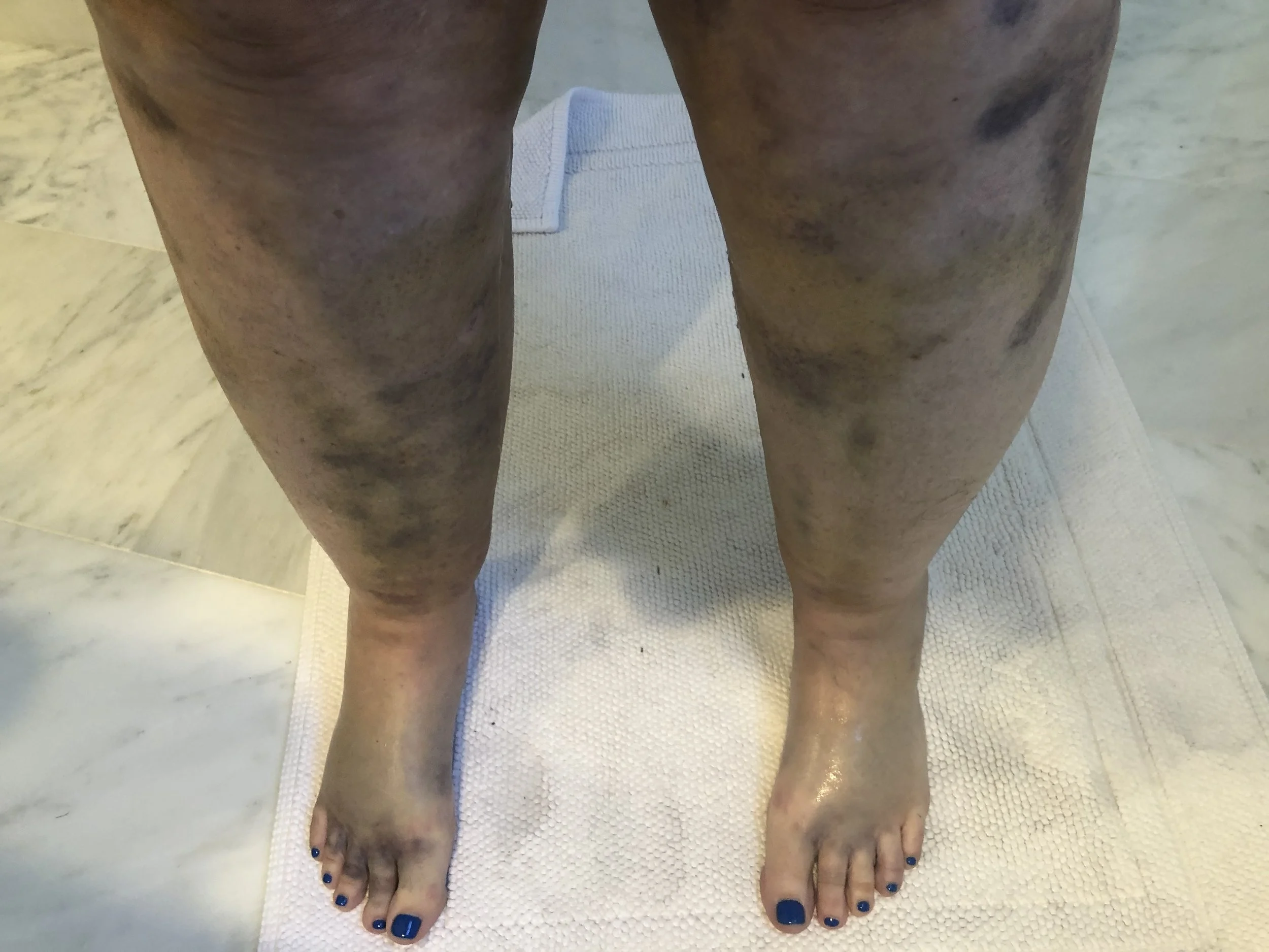 Person's legs with bruises standing on a white towel.