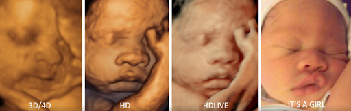 Can I Get a 4D Ultrasound if My Baby Is Facing the Wrong Way?
