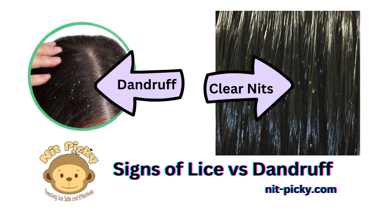 Dandruff vs. clear lice eggs