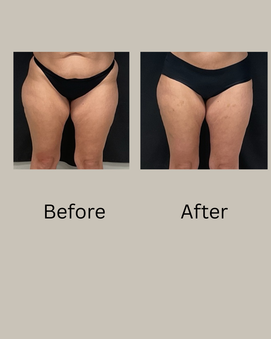 Before after photo thigh liposuction