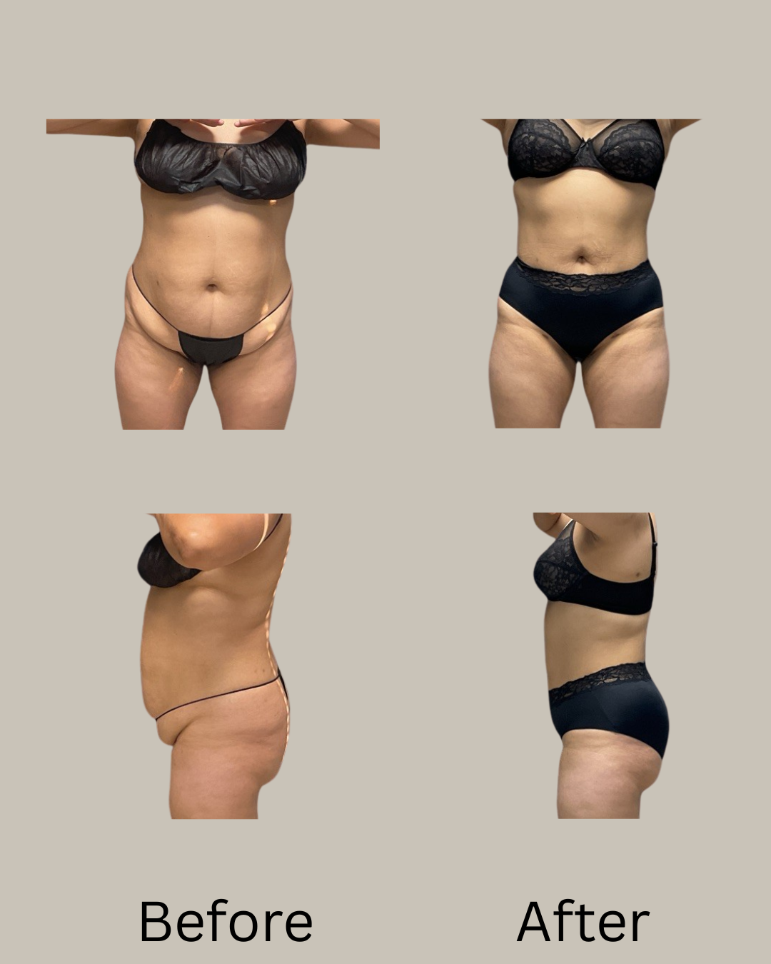 360 liposuction abs, love handles, back Milwaukee, WI
