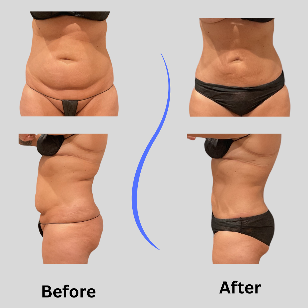 Side-by-side comparison of a woman's torso showing liposuction results, with 'Before' on the left and 'After' on the right.