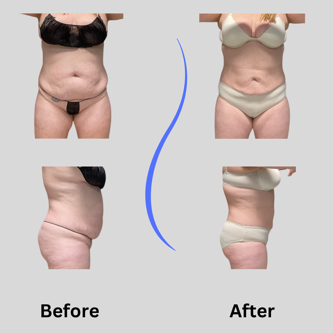 awake liposuction results abs and flanks woman wisconsin
