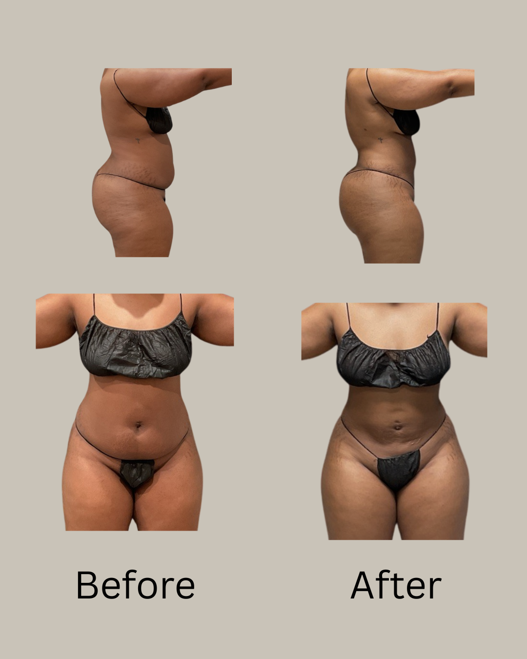Lipo360 before and after photo female