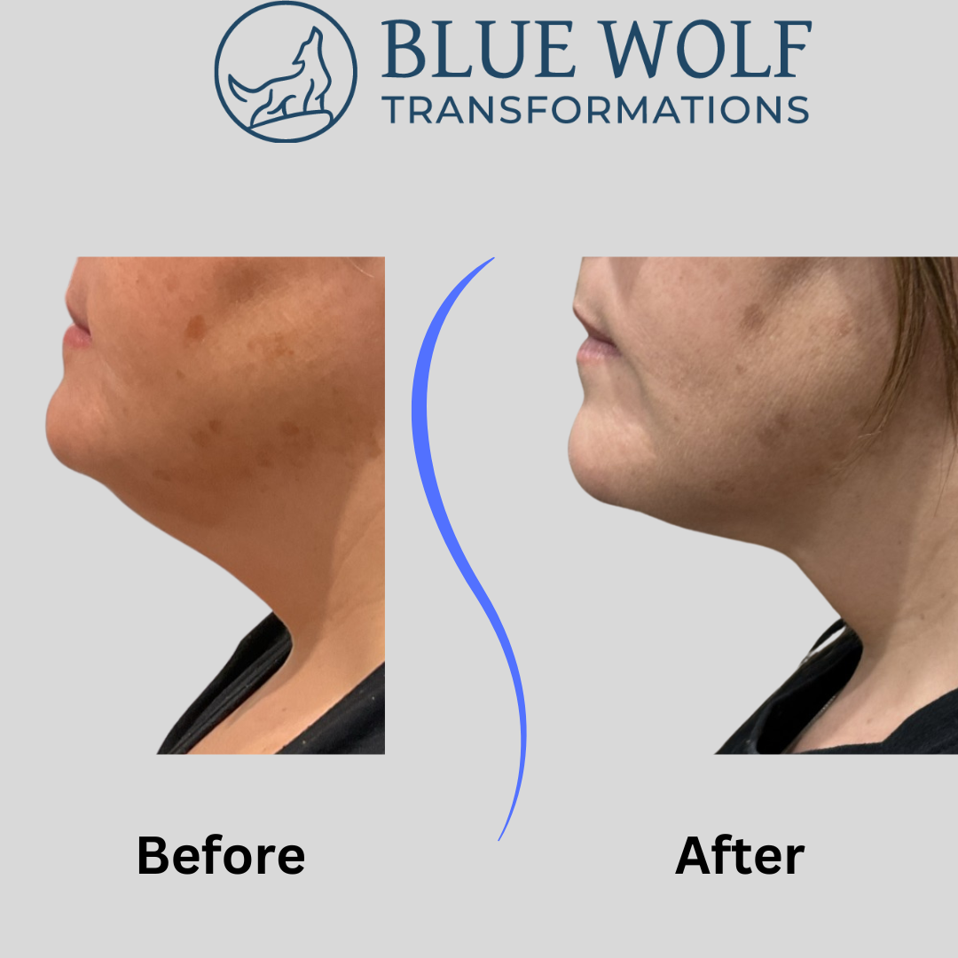website REB chin before after.png