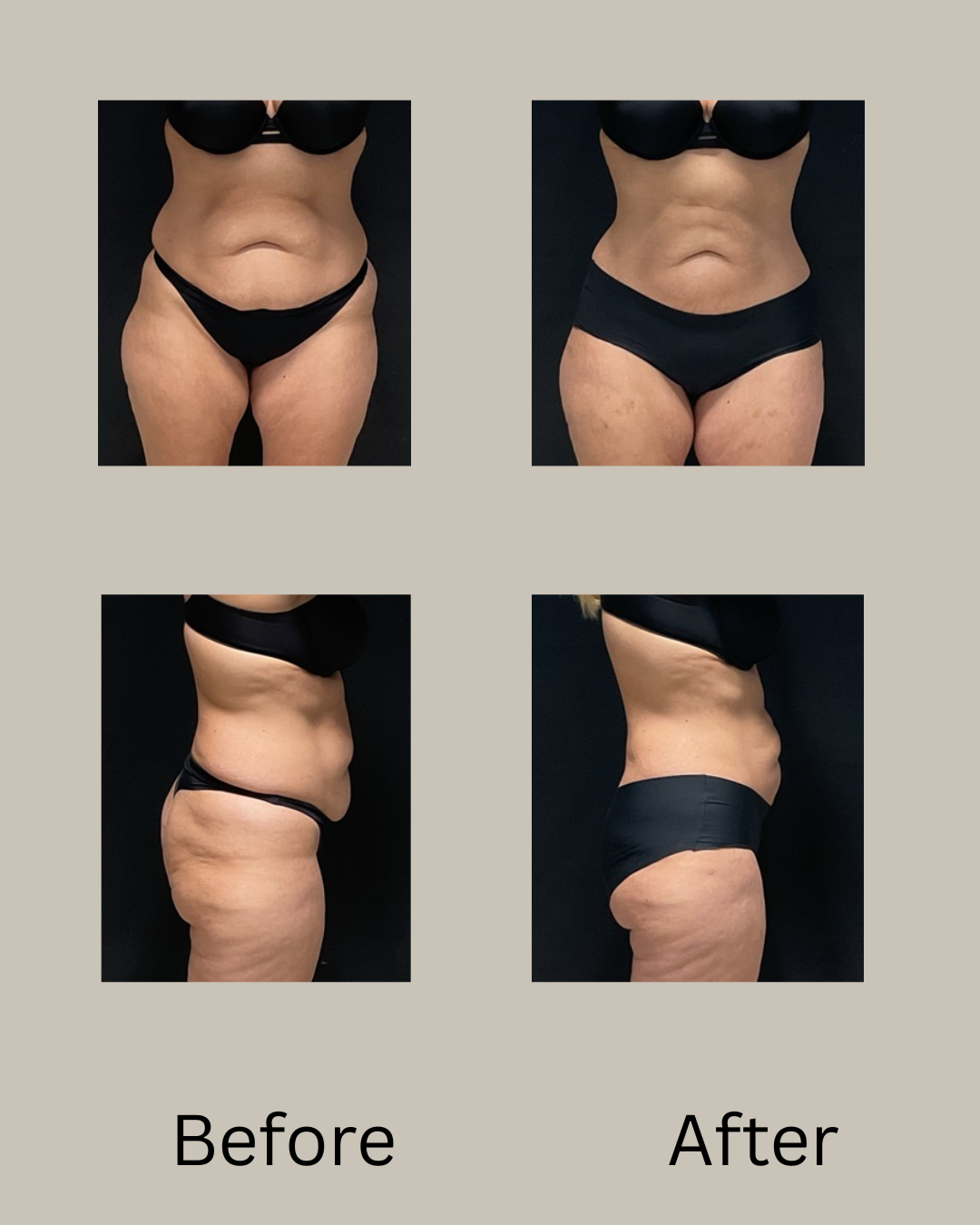 AF 360 thighs before after.png