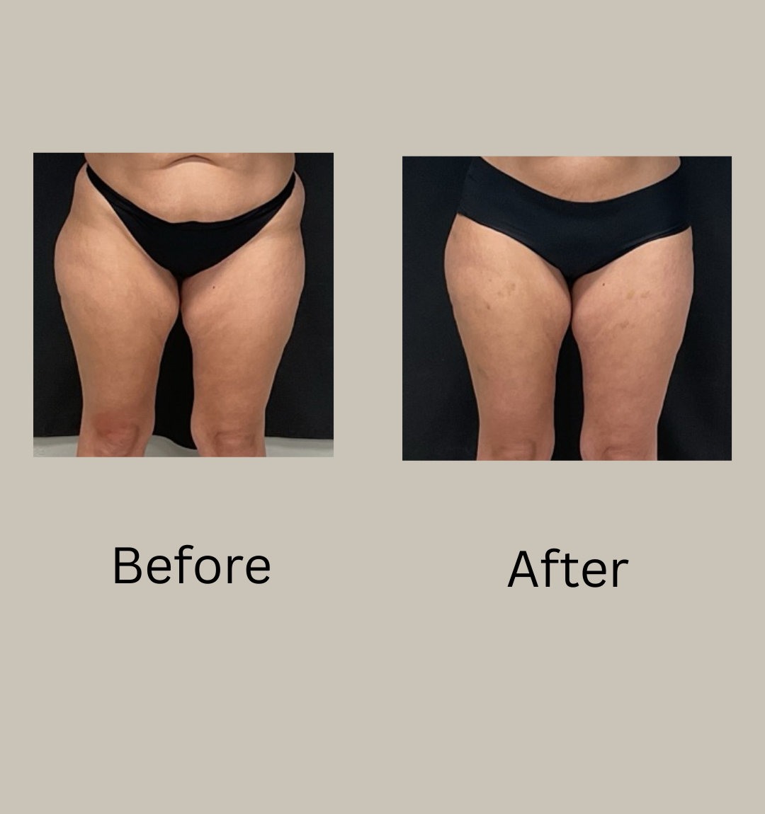 Thigh lipo before and after