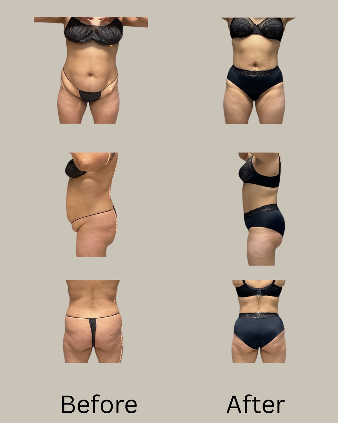 Comparison of a woman's body before and after awake lipo360, showing front, side, and back views in black underwear.