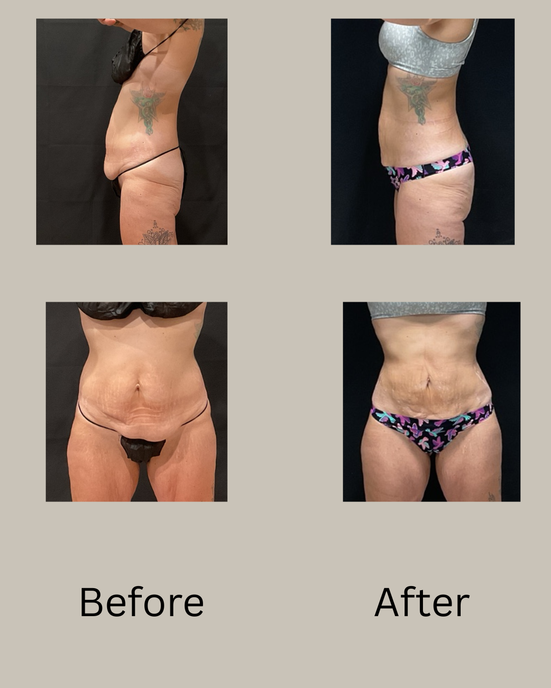Loose skin after Lipo360
