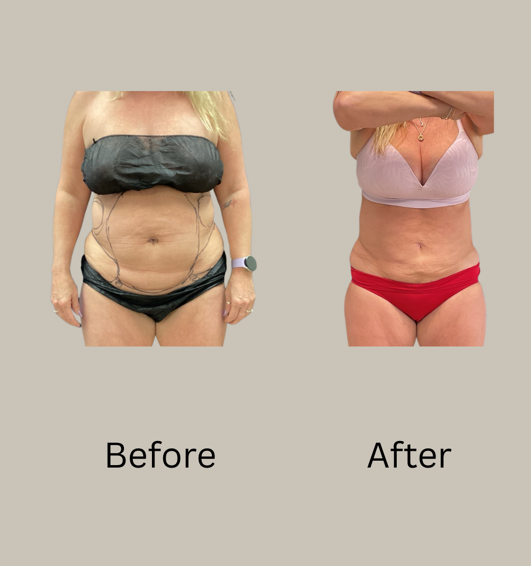 Blue Wolf Lipo360 Before and After Photos
