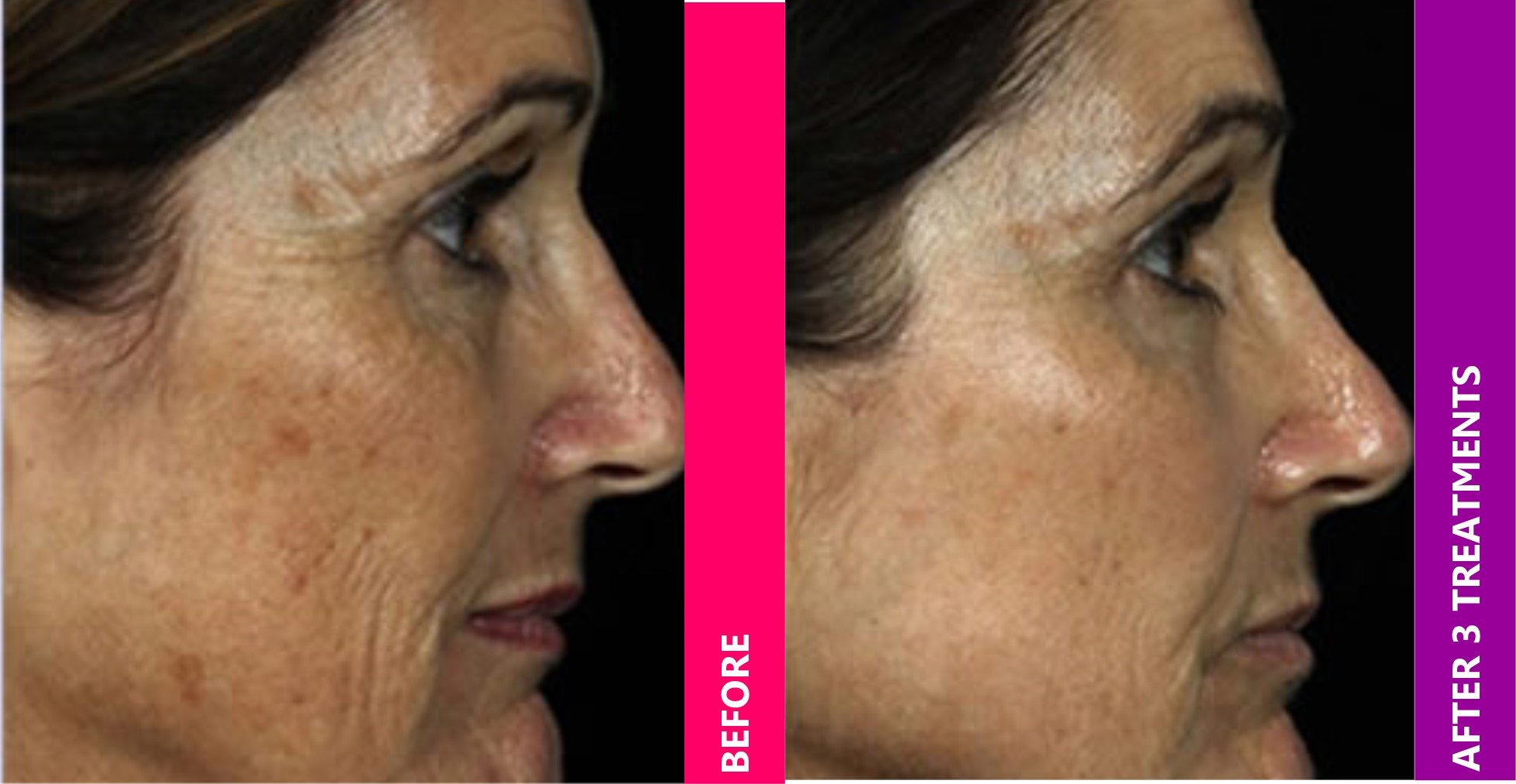 Microneedling Services in Encino, CA 91436 | Skin Protocol Medspa