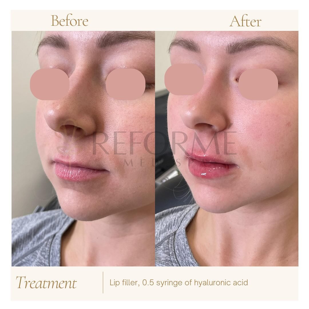 💋 Achieve perfect lips with a naturally elegant touch! Our lip filler treatments are designed to provide subtle correction that enhances your beauty without overdoing it. Enjoy a result that beautifully highlights your lips in a natural and harmonio