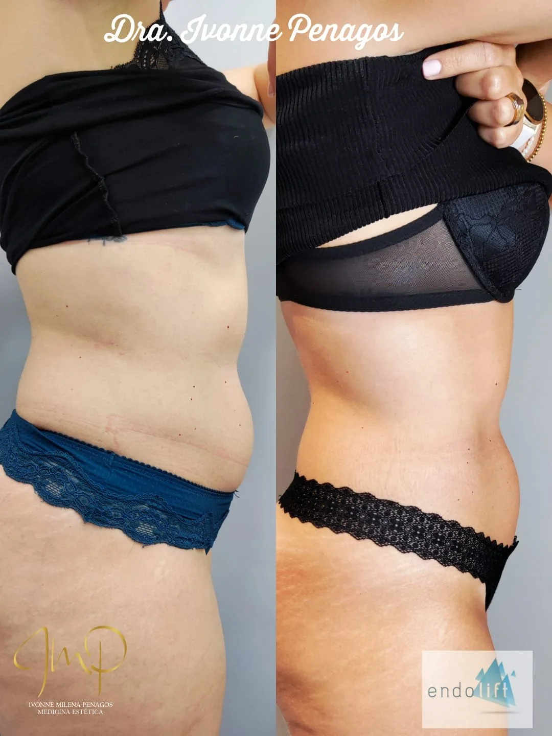 Endolift en Abdomen