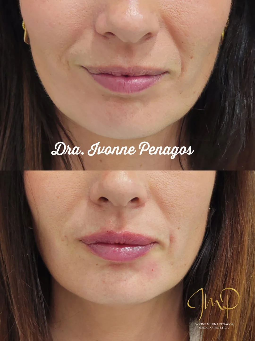 Tratamiento de Labio