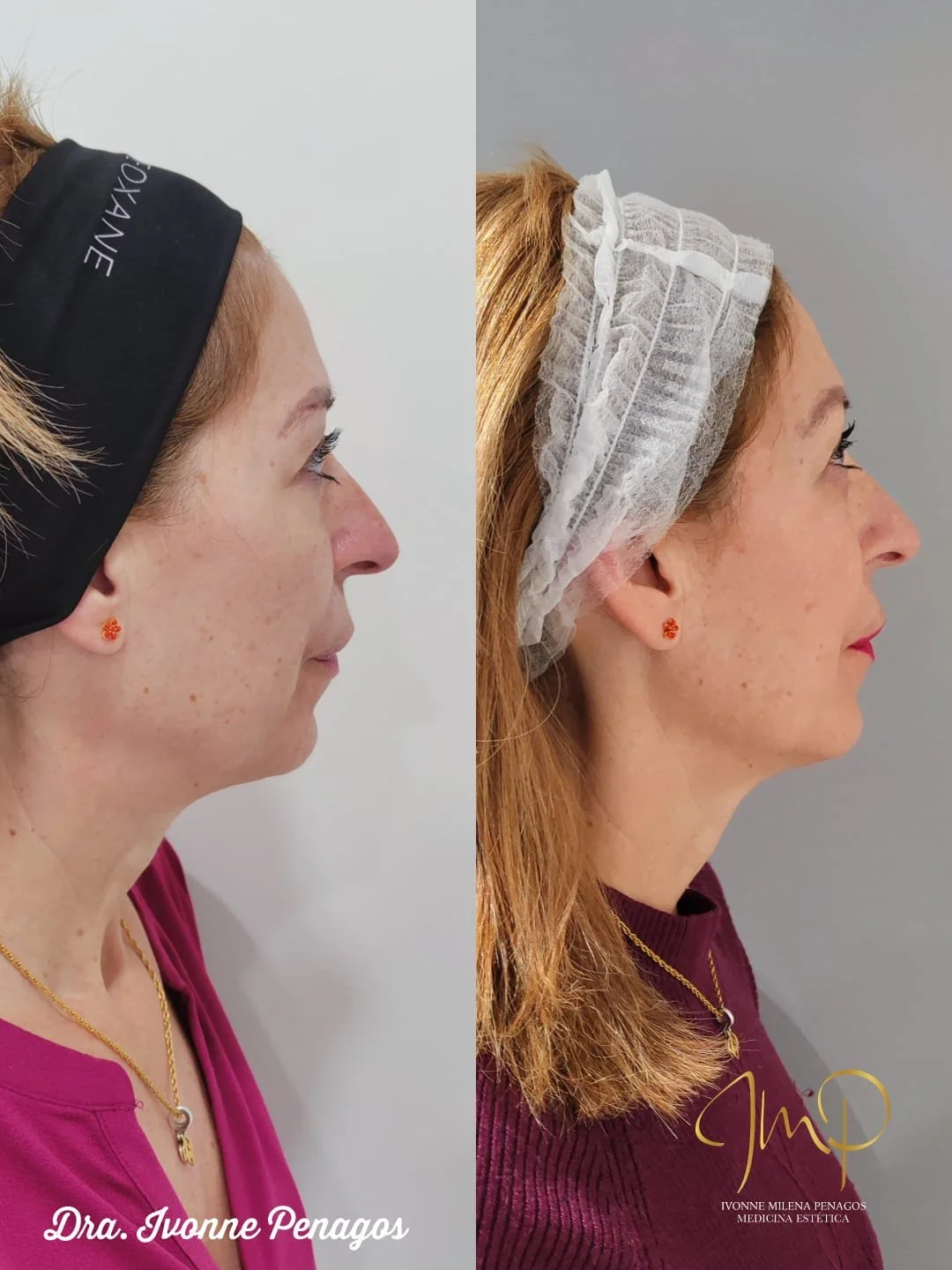 Endolift Facial 