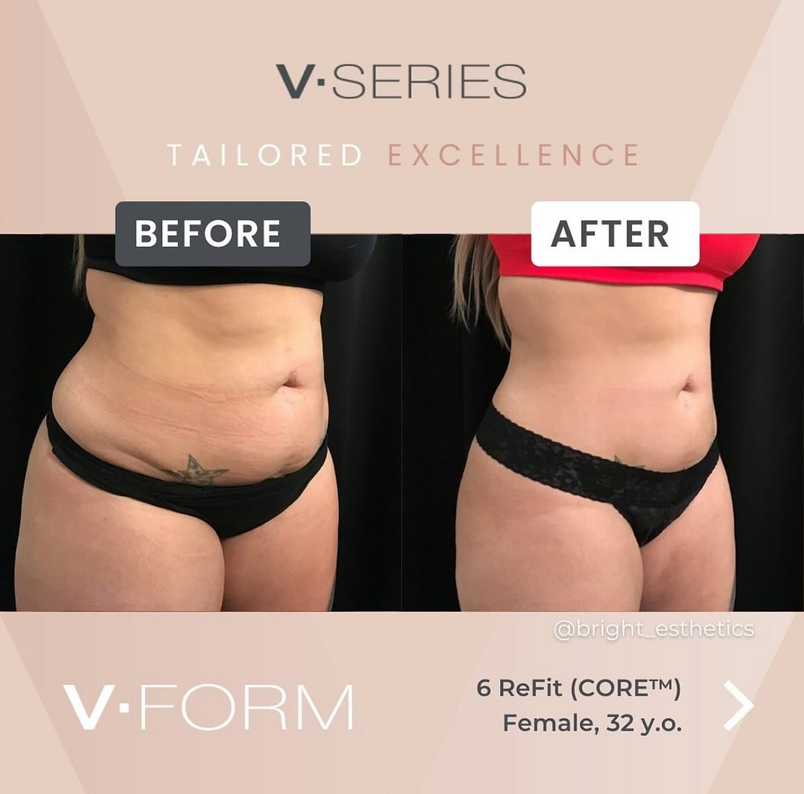 No Pain, All Gain: V-FORM delivers long lasting, life changing results, without the need for any incisions or anesthesia. 

RF energy works on the sub-dermal level stimulating collagen production, restoring skin elasticity, and blasting away fat cell