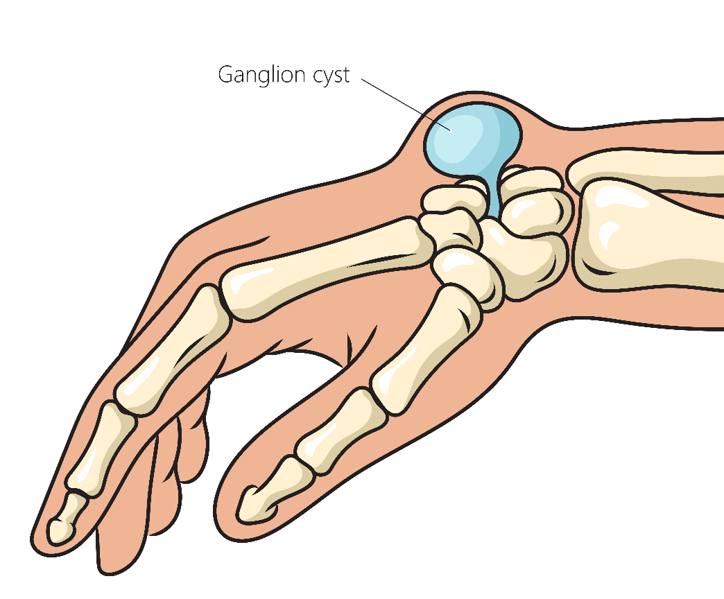 Kayste Kyste arthrosynovial du poignet — Dr Sturbois Nachef