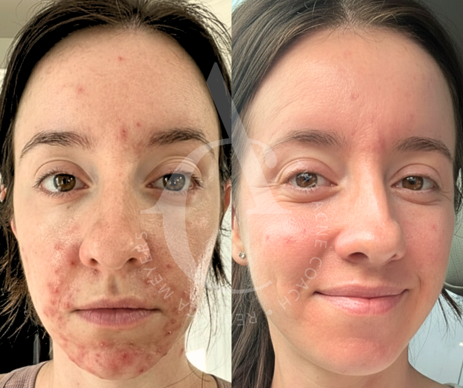 Copy of Before & After Photos with Watermark, Rebecca Meyers, The Acne Coach (1).png