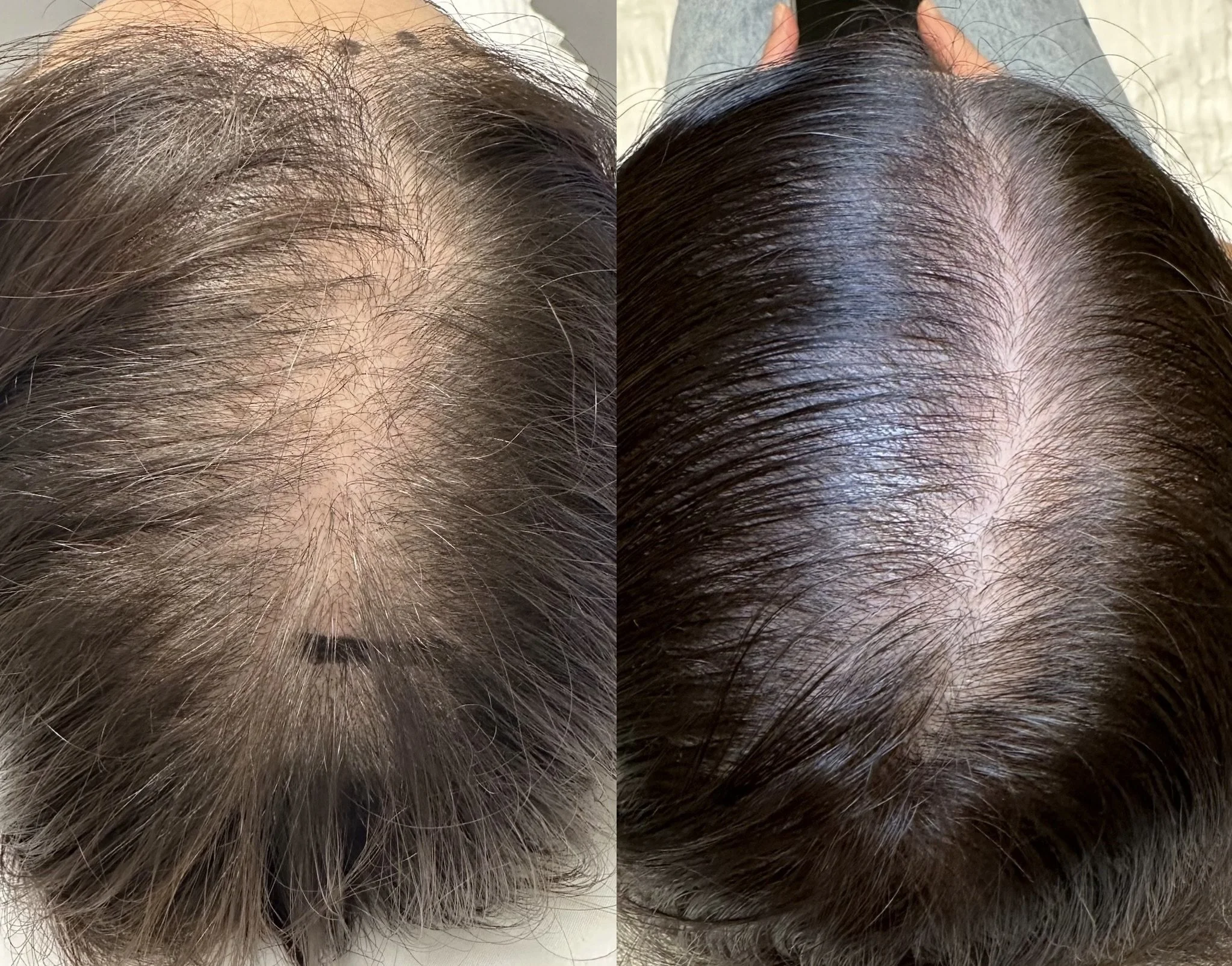 Before and after images of a person's scalp showing improved hair density and reduced thinning on the top of the head.