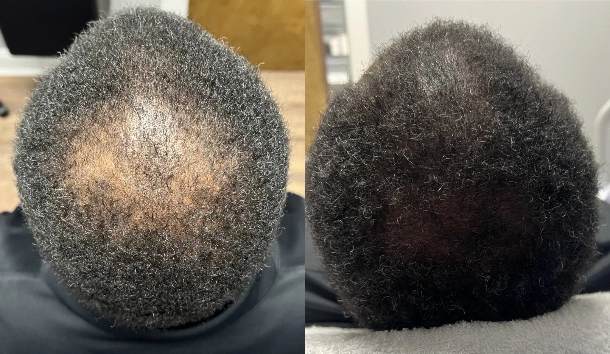 Comparison of the top of a person's head before and after hair growth treatment, showing significant hair regrowth and thickening.