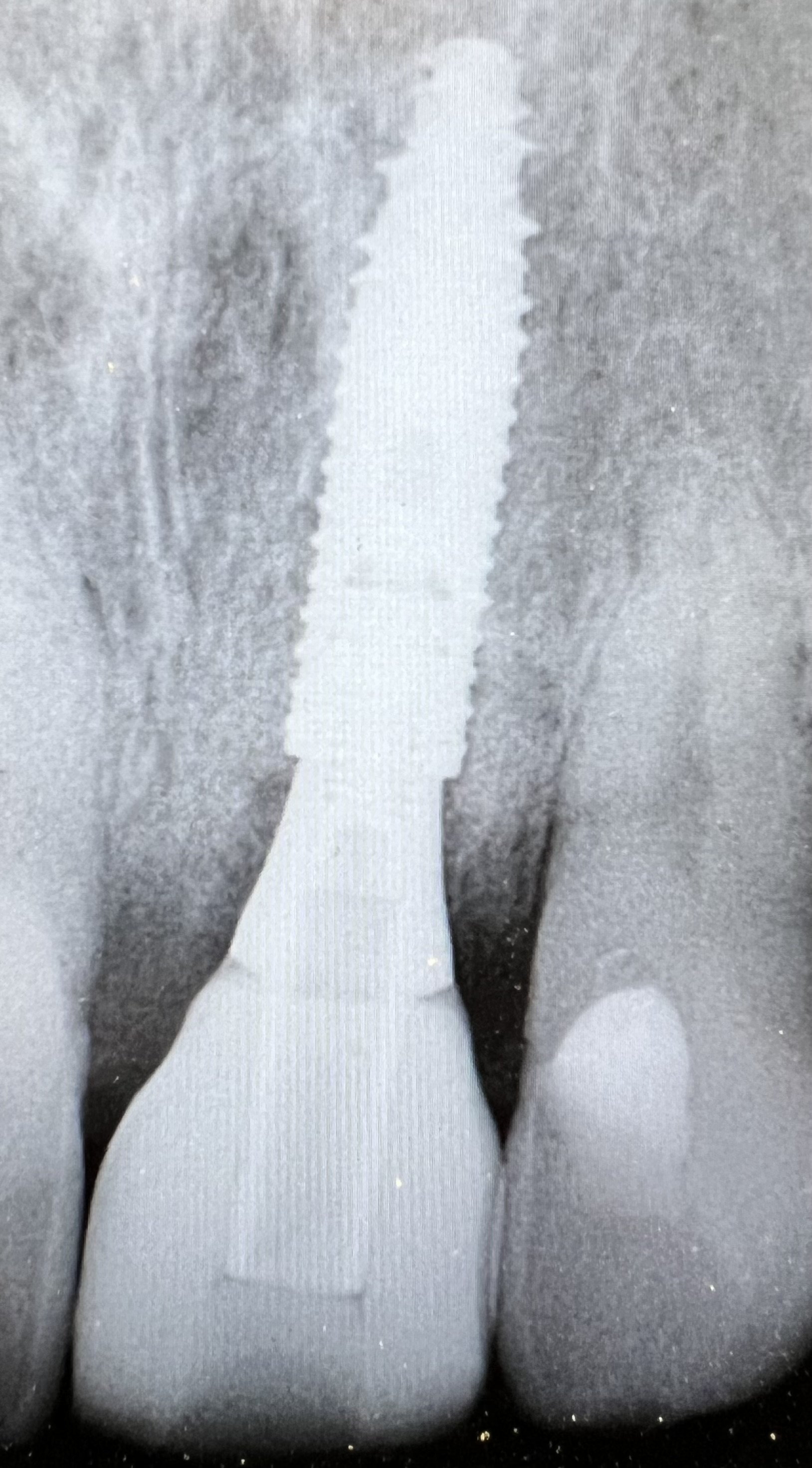 anterior implant xray.jpeg
