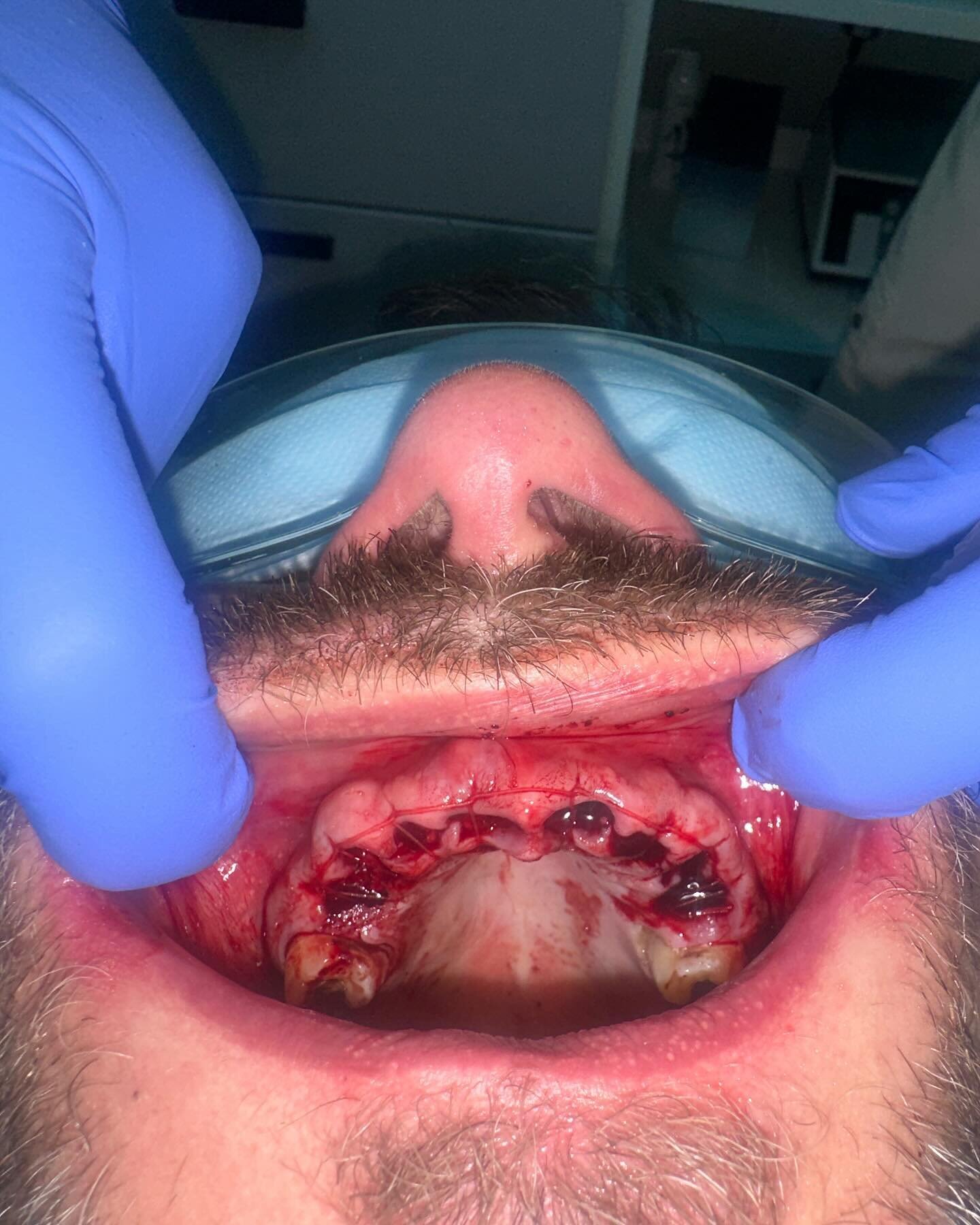 Tidy 😷
I had a great morning sedating this lovely gentlemen for (virtually) a full clearance.
A very complicated medical history meant this patient was turned away from a number of dental practices and was refused GA after referral to hospital.
W