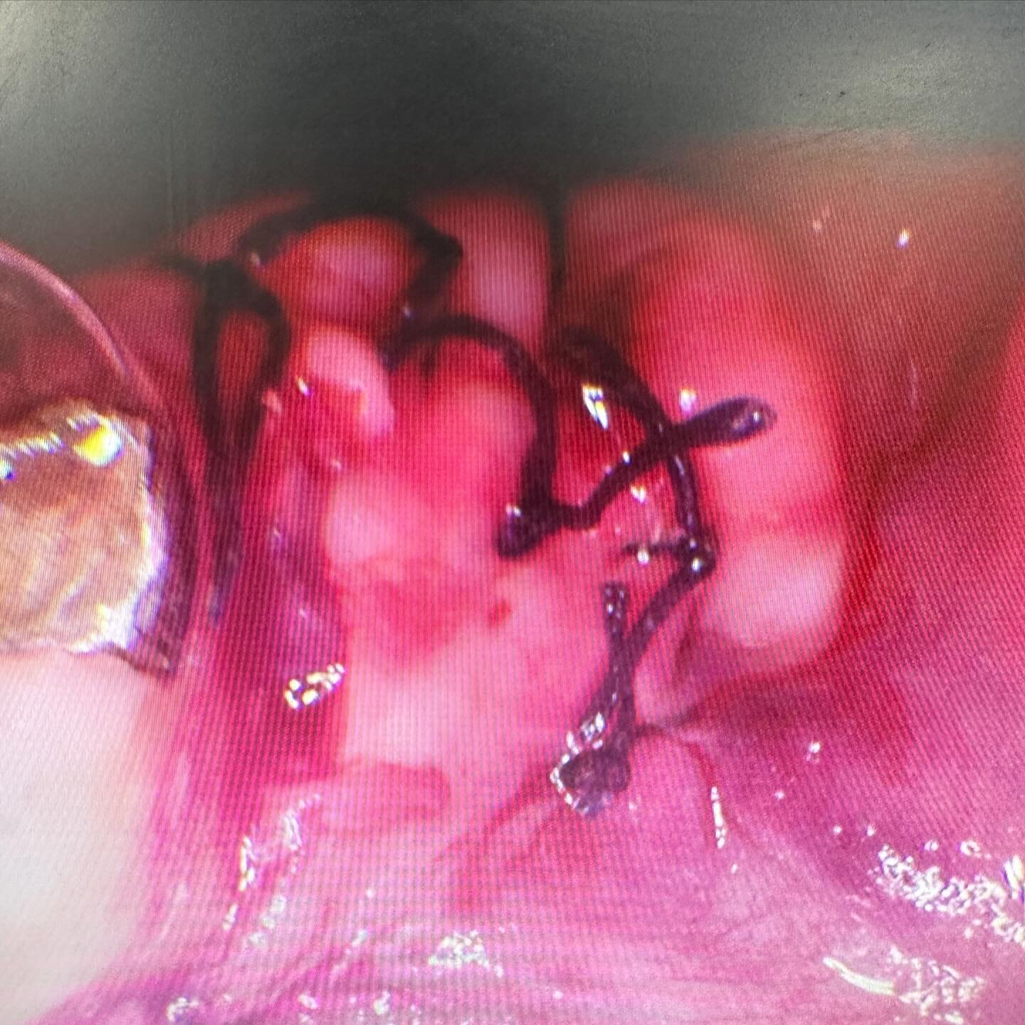 OAC? What OAC?
Helping out a colleague after a rather large hole presented itself post extraction…