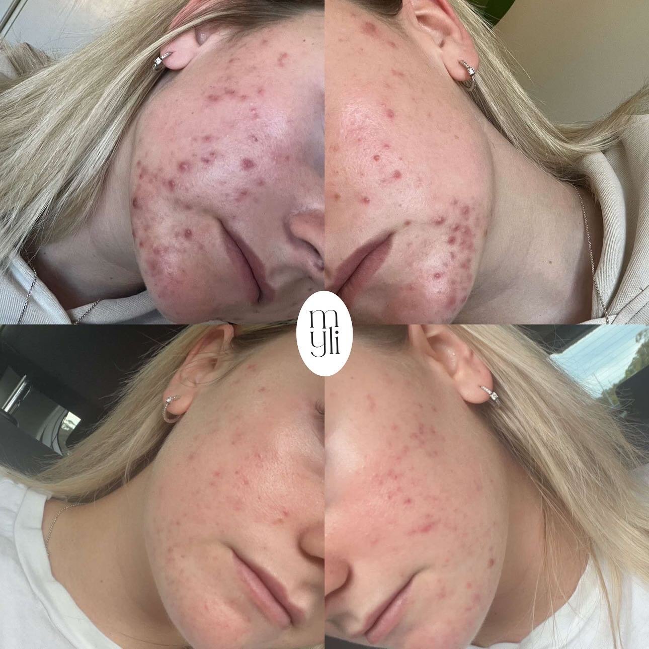 The skin transformation of my dreams 🤎 

These results were achieved with consistent, good quality skincare &amp; in clinic OCosmedic Bespoke Corrective treatments once a month. The OCosmedic difference 🙌🏽

We worked on calming and soothing the an