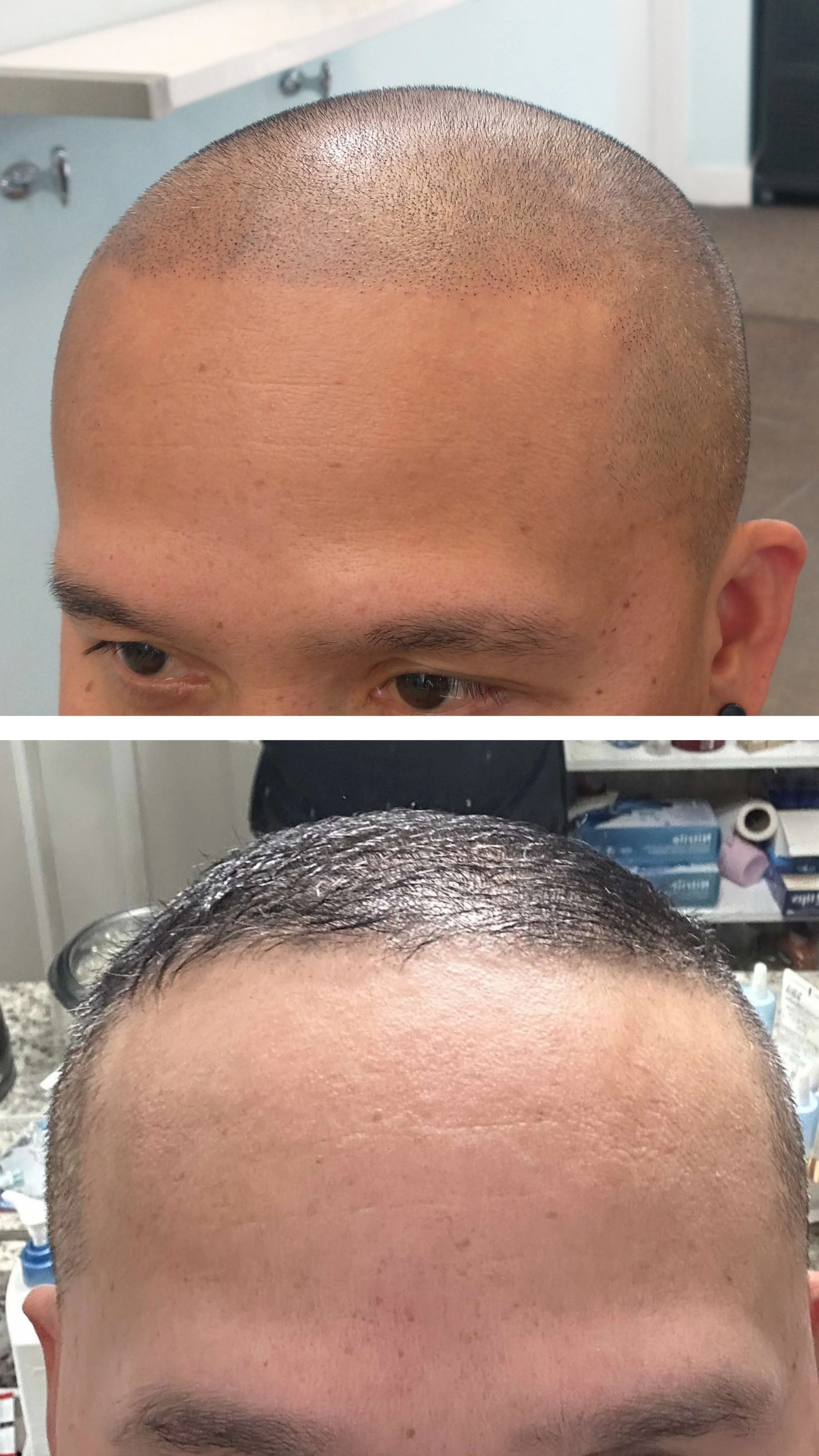 Client now looks 10 years younger after his scalp micropigmentation (SMP) treatment, with a rejuvenated, natural-looking hairline. The SMP procedure restored thickness and confidence, turning back the clock on his appearance. SMP is the ideal solutio
